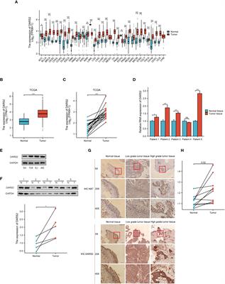 Prognostic biomarker DARS2 correlated with immune infiltrates in bladder tumor